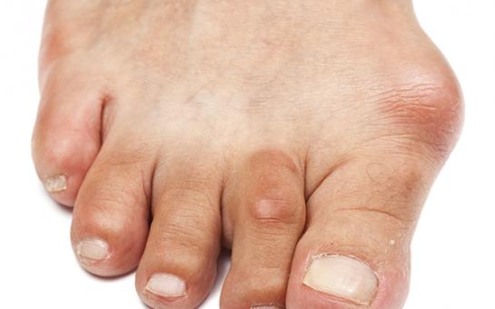 Picture of Gout: treatment & management